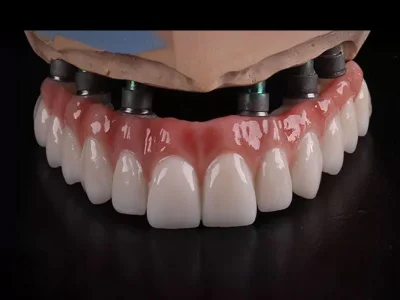 Üstten Vidalı İmplant Üstü Porselen