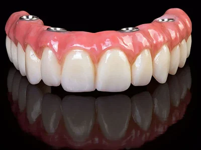 İmplant Üstü Porselen